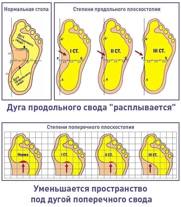 Плоскостопие и военная служба причины по которым его не принимают в армию